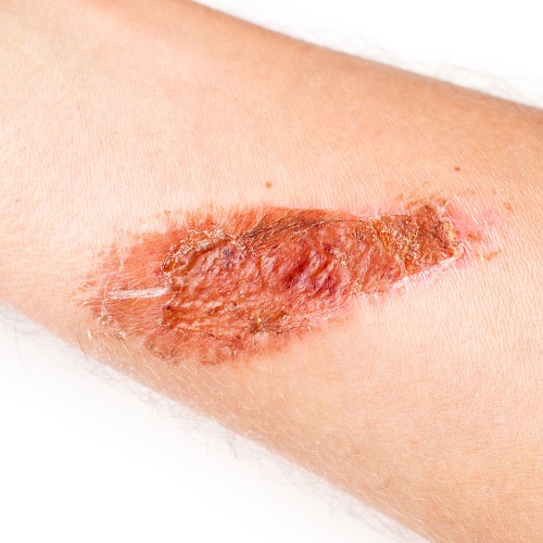 צלקת מכוויה