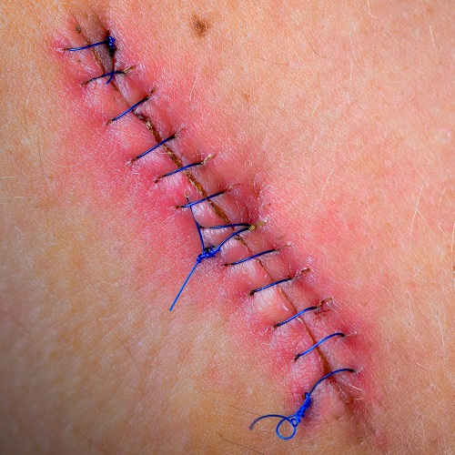 צלקת מניתוח פלסטי